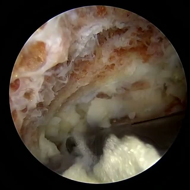 Endoscopic operative field
