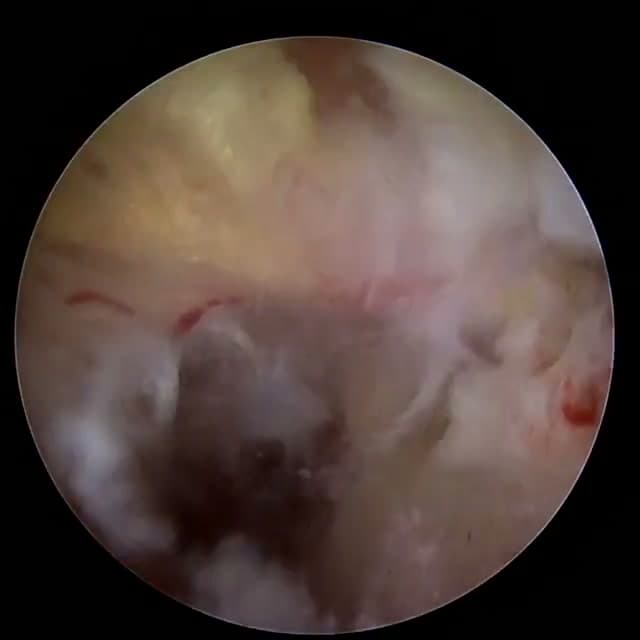 Endoscopic operative field