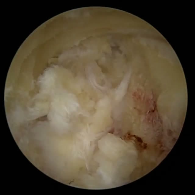Endoscopic operative field