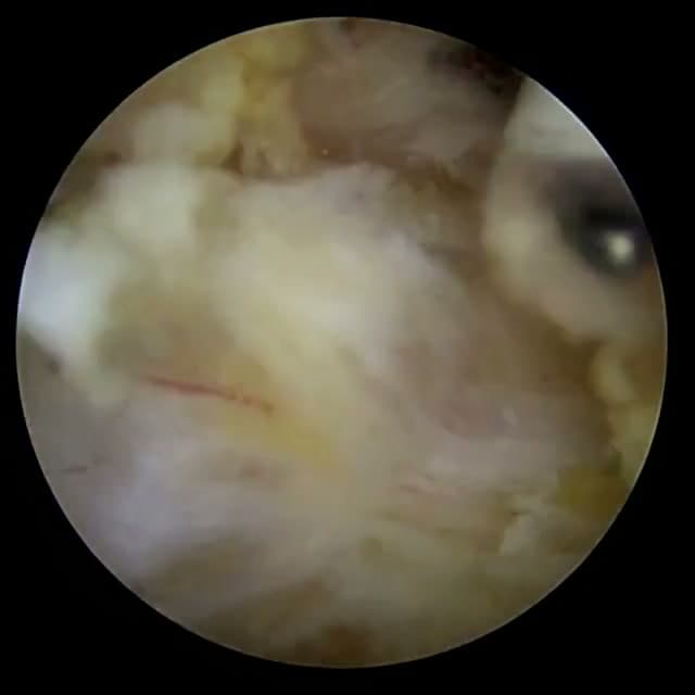 Endoscopic operative field
