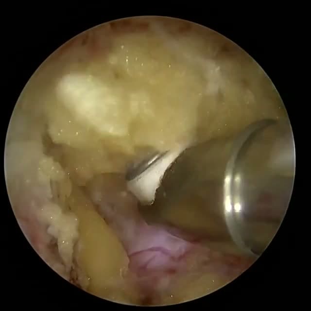 Endoscopic operative field